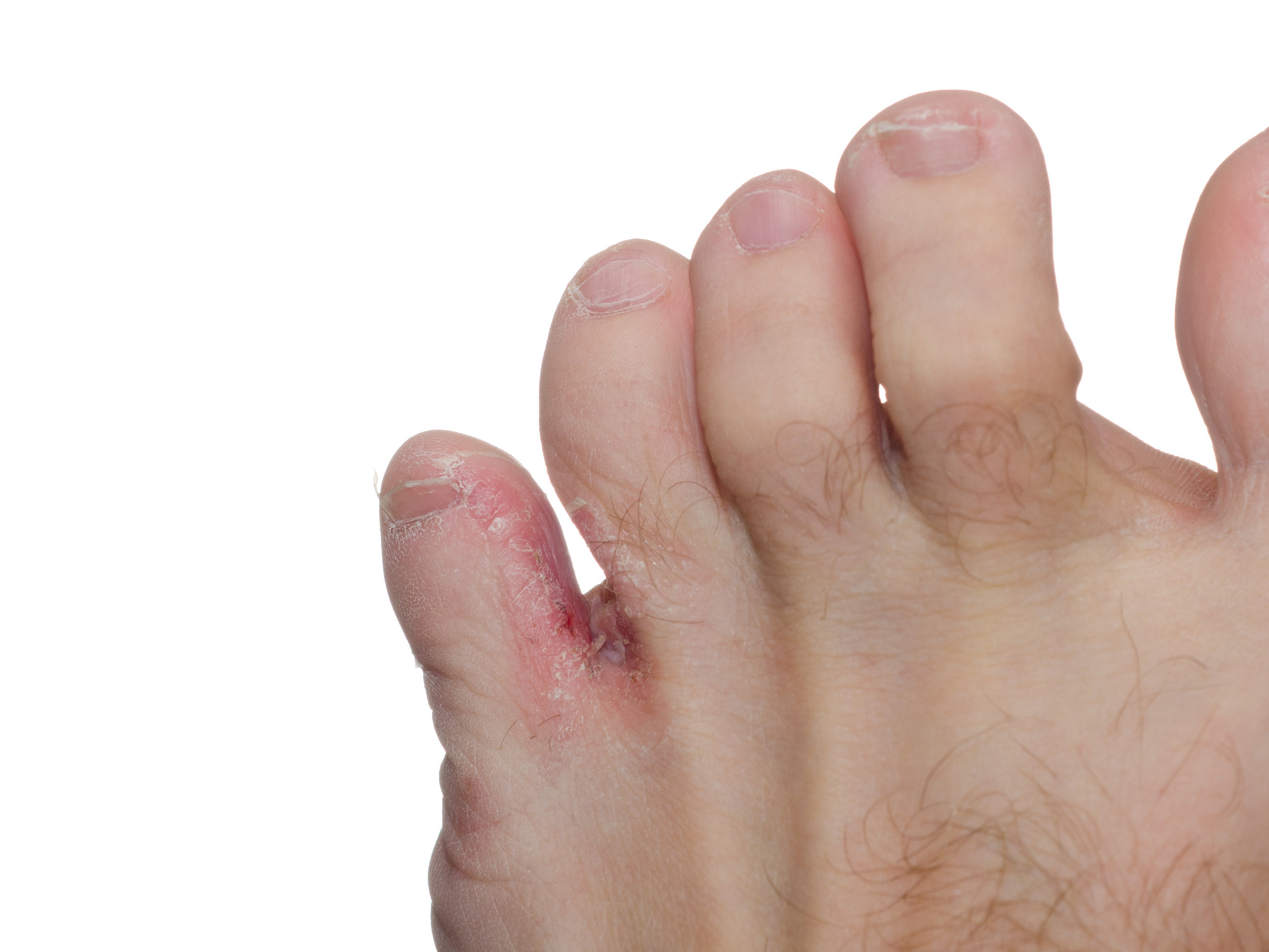What causes white toenails and how do I fix them? - Austin Podiatry