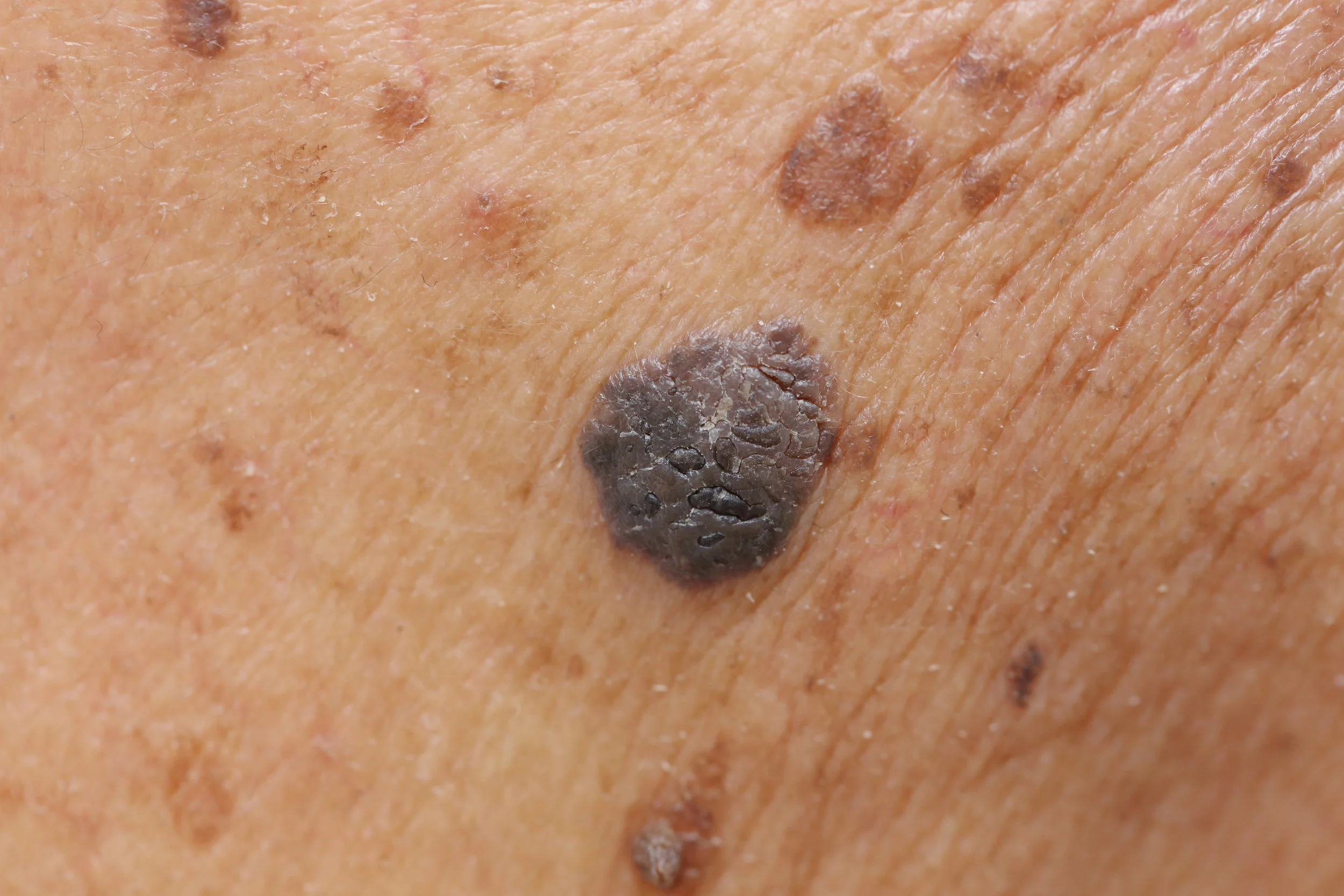 Seborrheic Keratosis _80923216.jpeg