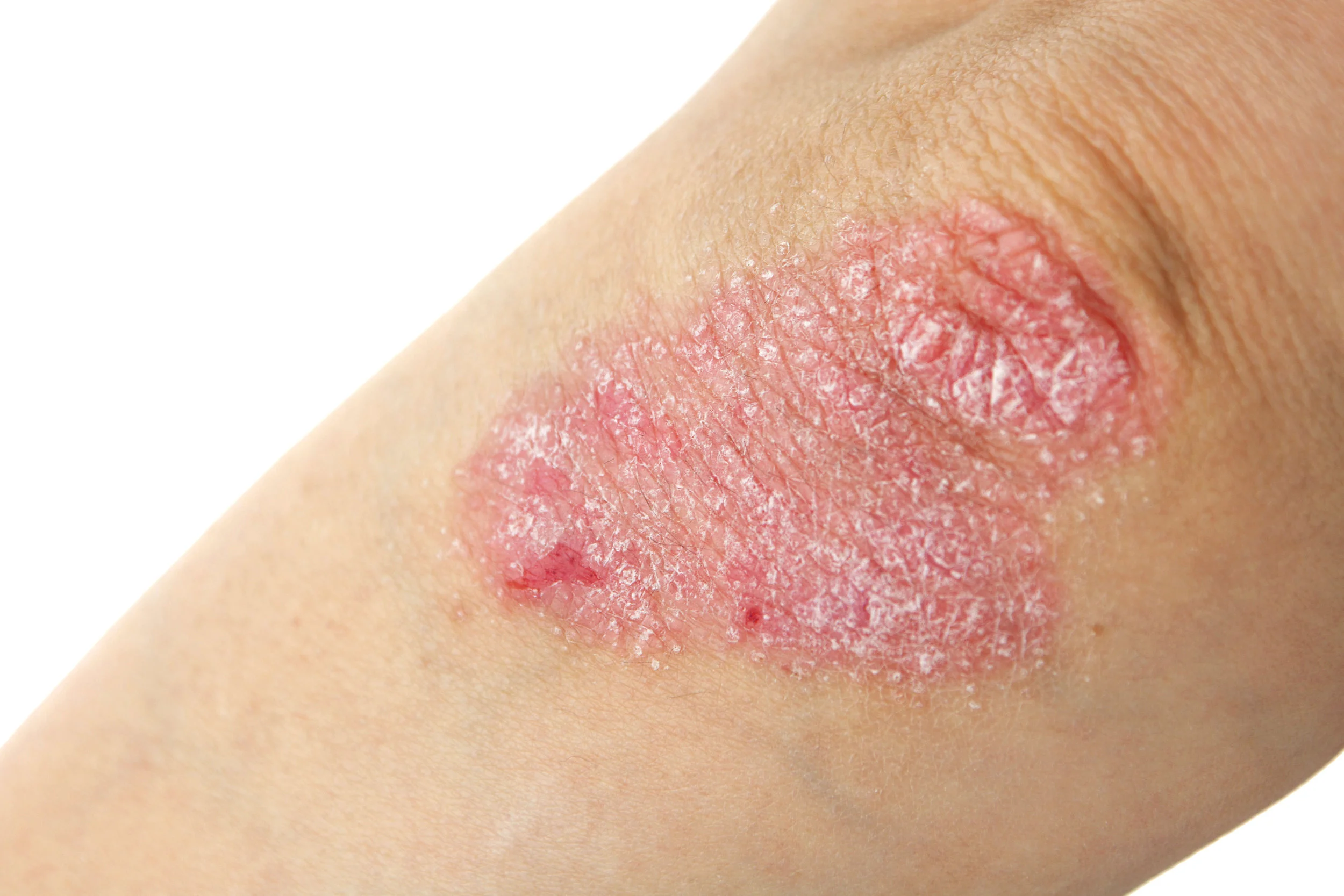 psoriasis.jpg