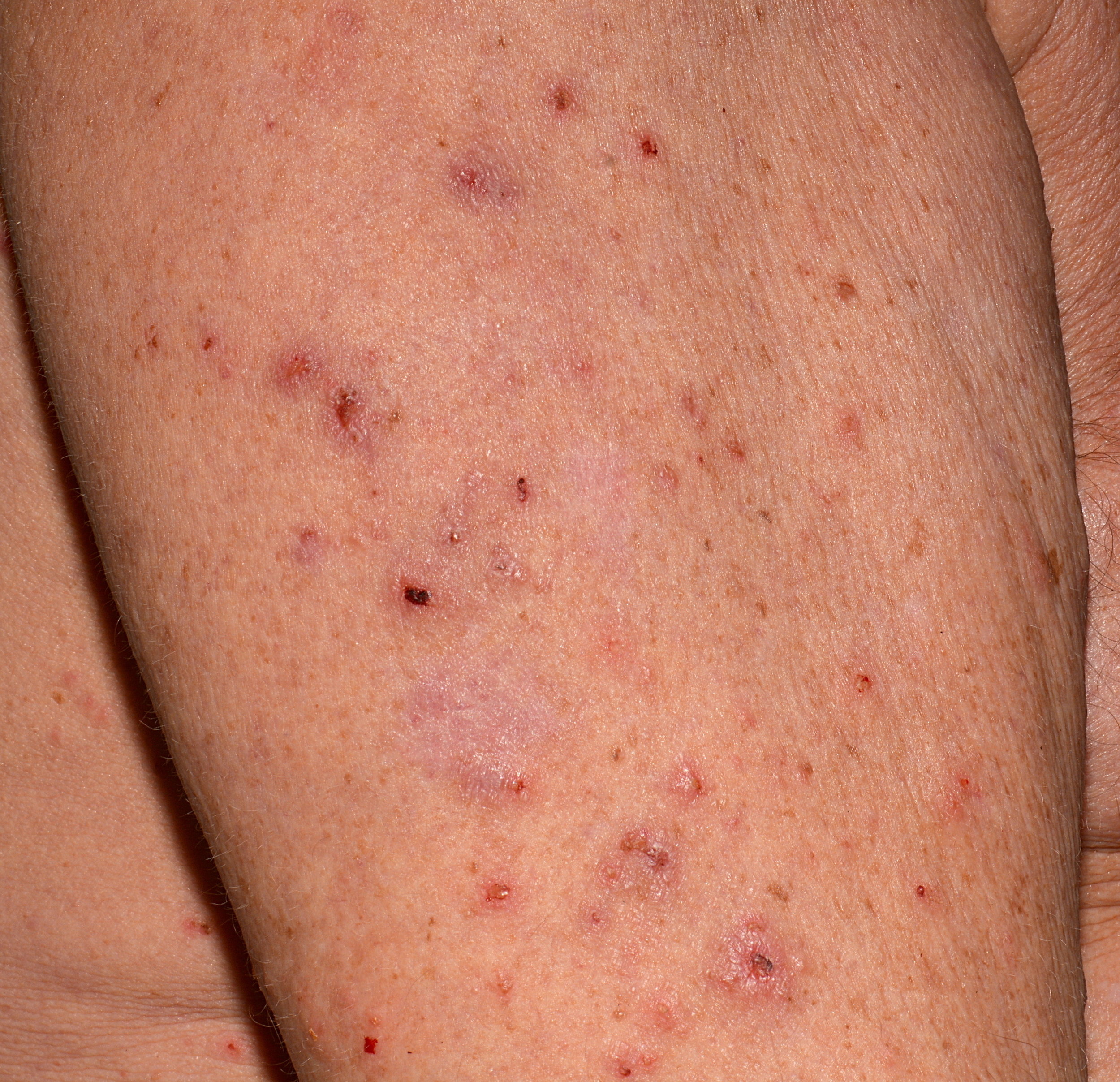 Scabies Rash