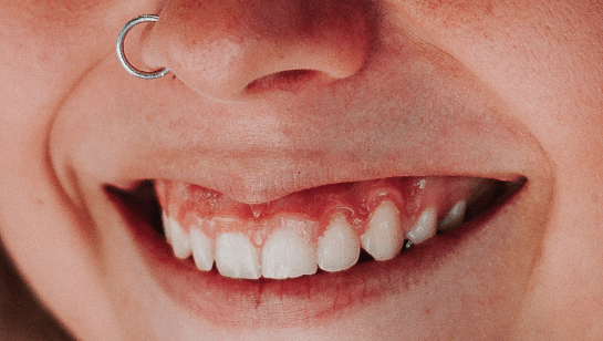 Gingivectomy Treatments Options Recovery Cost