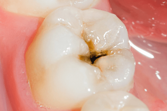 Cavities Tooth Decay Symptoms Causes And Treatments