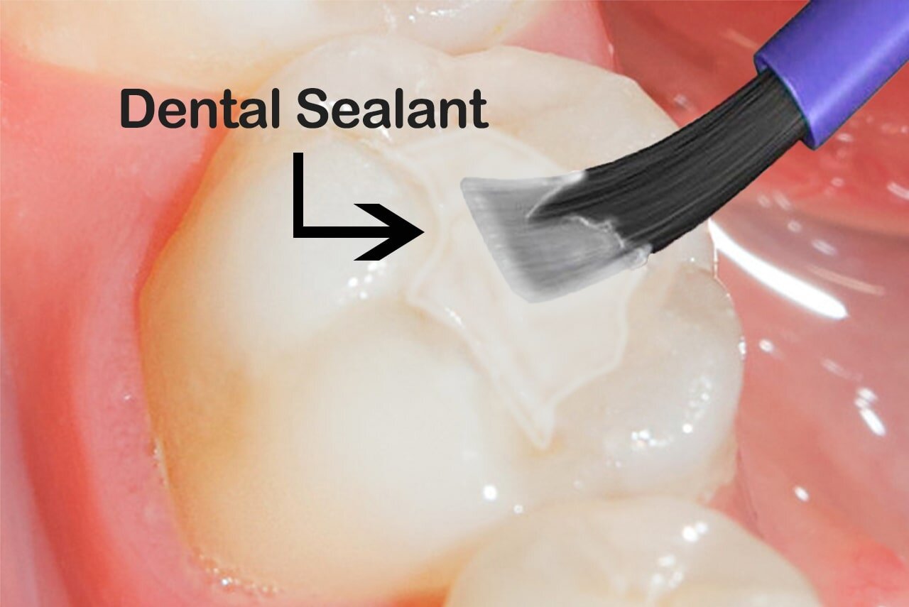 Dental Sealants Do You Need Them Are They Safe Teeth Talk Girl