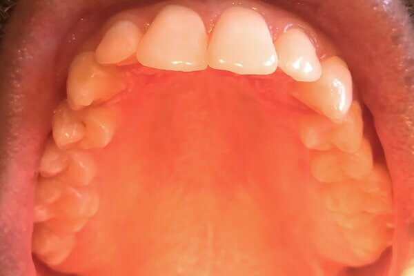 8 Reasons Why The Roof Of Your Mouth Is Itchy