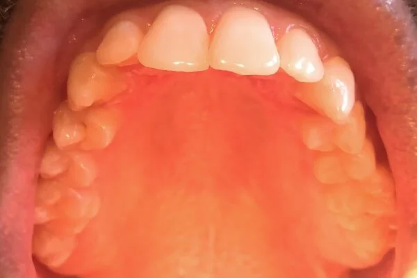 8 Reasons Why The Roof Of Your Mouth Is Itchy