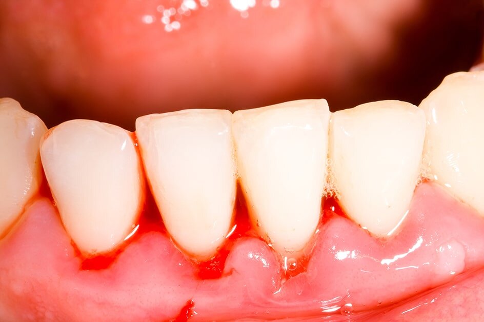 Why Are My Gums Swollen? | Causes, Treatment, & Prevention