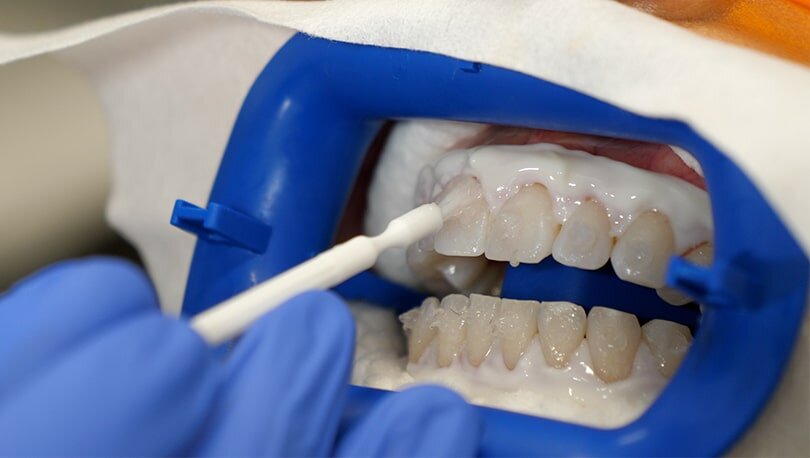 Laser Teeth Whitening Boise - Organic, FDA Approved - Idahome Smiles