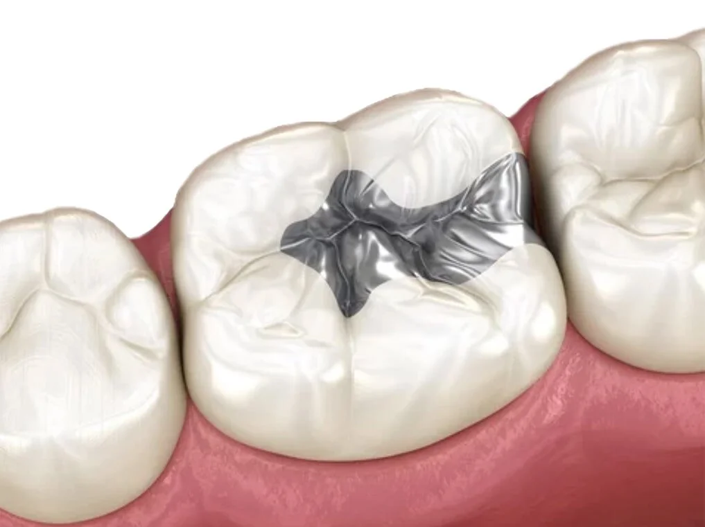 Silver Amalgam Dental Filling