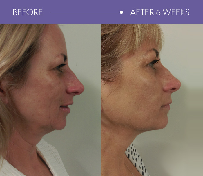 hifu-before-and-after-1.jpg