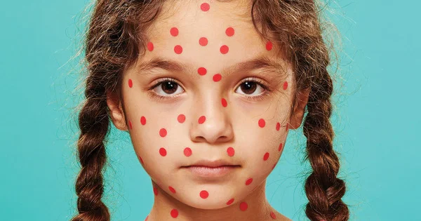 measles-01.w1200.h630.jpg