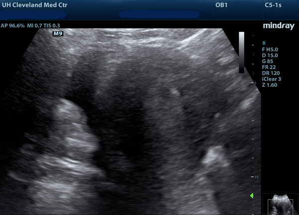 Pseudogestational%20sac%20and%20FF.gif