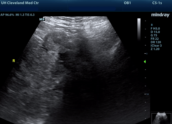 ectopic%20-%20adnexal%20mass.gif