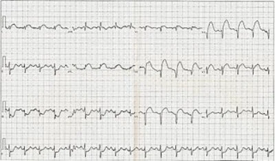 320px-12_Lead_EKG_ST_Elevation_tracing_only.jpg
