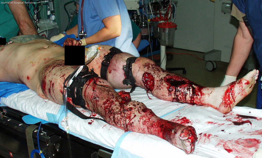 Blast Injuries