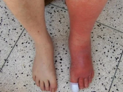 Cellulitis_Left_Leg.jpg