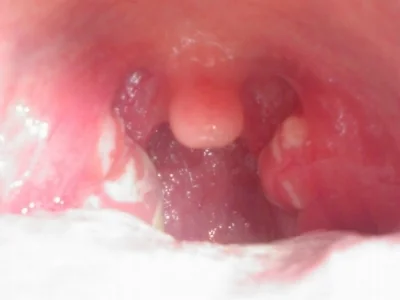Streptococcal_pharyngitis_1.jpg