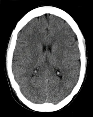 Brain_CT_scan.jpg
