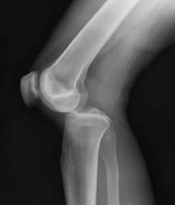 PosteriorKneeDIsclocation.jpg
