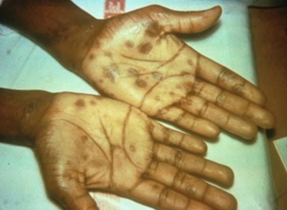 Secondary_syphilis-palmar_rash.png