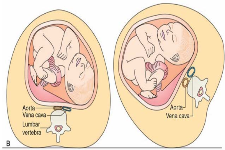 aortocaval-compression.png