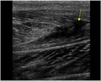 Muscle Tear