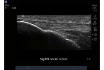 Normal Patellar Tendon