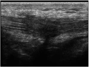 Patellar tendon rupture