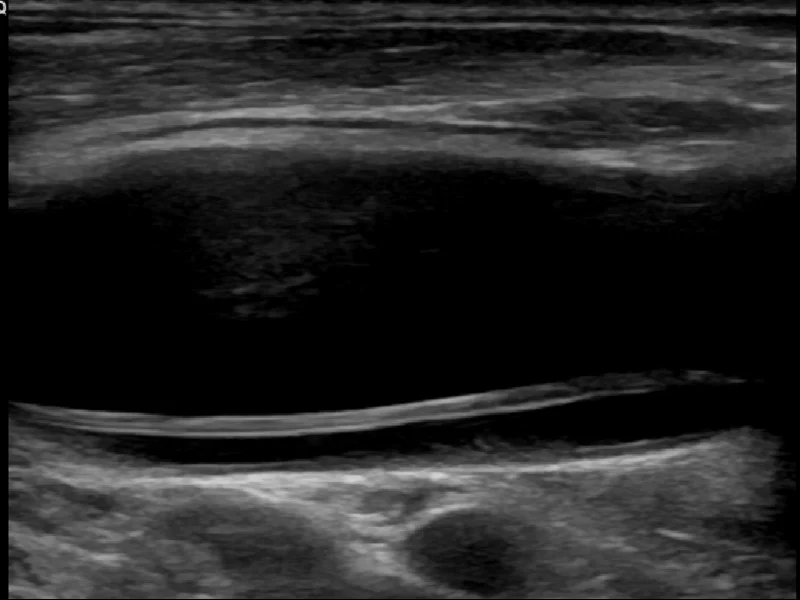Carotid Dissection with Intimal Flap