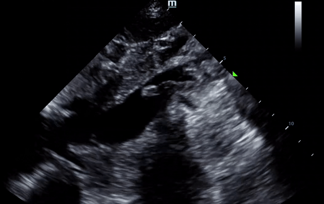 ivc clot.gif