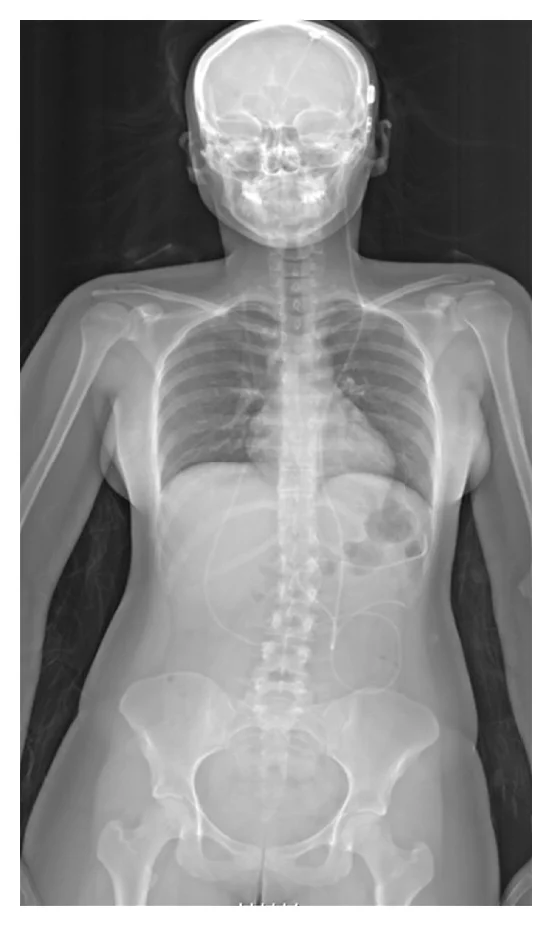 Radiograph_of_a_ventriculoperitoneal_shunt.jpg