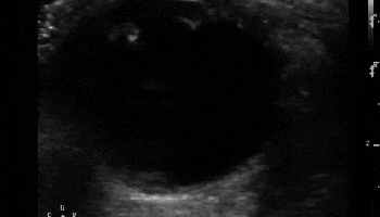 Retinal Detachment courtesy of ALIEM.com