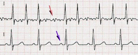 Afib_ecg.jpg
