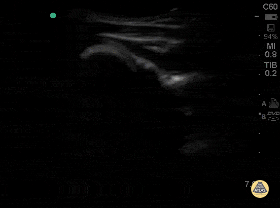 Normal shoulder