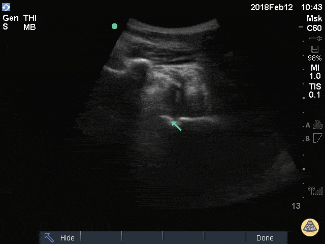 Anterior dislocation, humeral head displaced farther from the probe