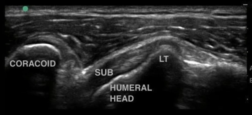 Subcapsularis (normal) msksono.com
