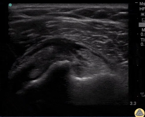 Subscapularis Tear