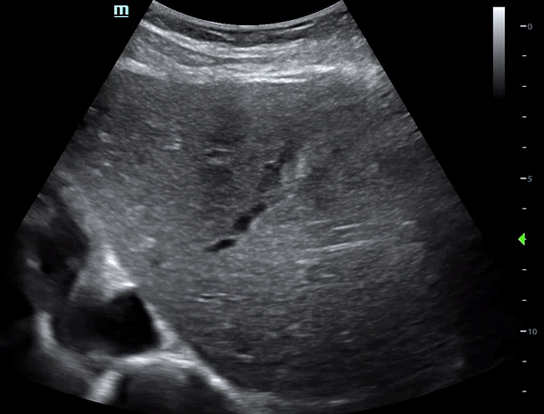 gallstones long.gif