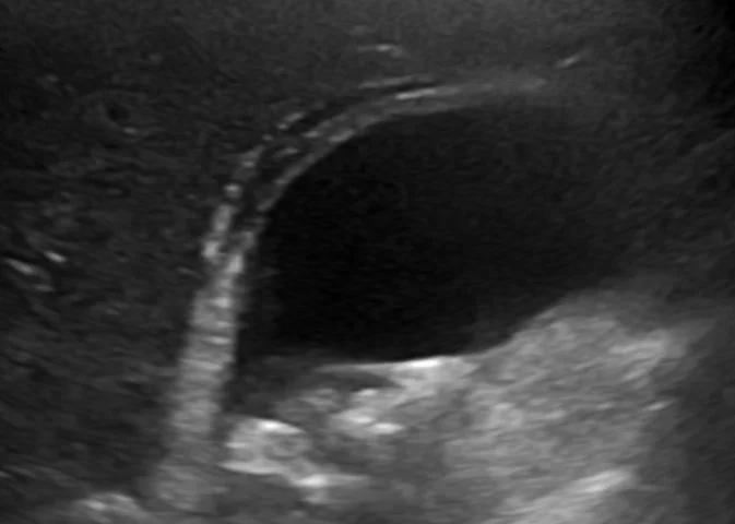 cholecystitis.jpg