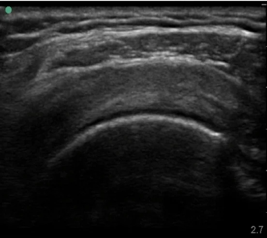 Supraspinatus (normal short axis) https://theultrasoundspace.co.uk