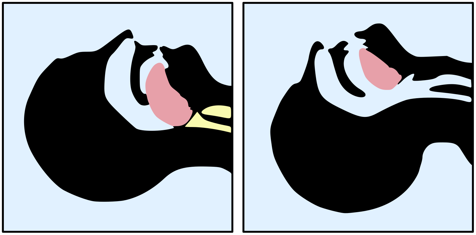 Tongue_blocking_airway.png