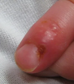 Herpetic_whitlow_in_young_child.jpg