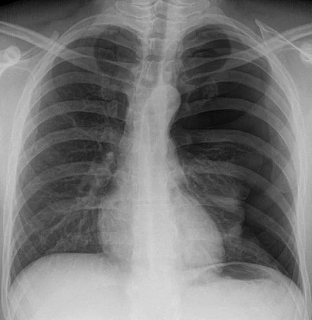 440px-Spontanpneumothorax.jpg