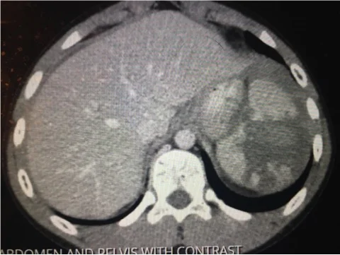 Grade III/IV Splenic Laceration