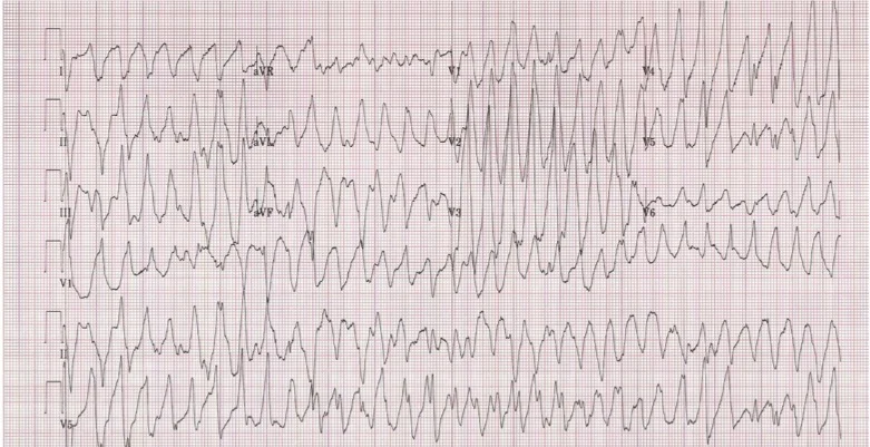 Torsades de Pointes