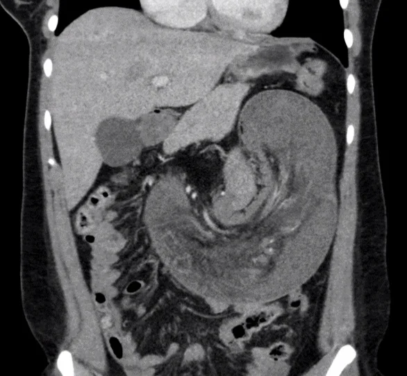 CT showed: mesenteric volvulus, thickened bowel wall, free air