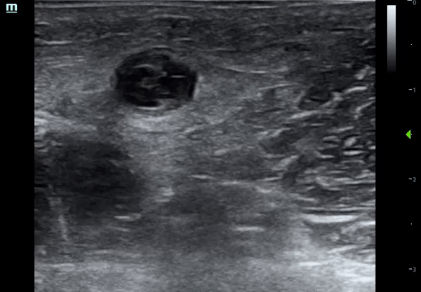 thrombophlebitis3.gif