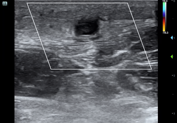 thrombophlebitis2.gif