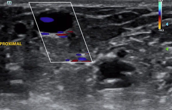 thrombophlebitis5.gif