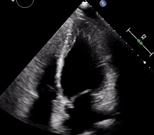 Intern Ultrasound of the Month: Peripartum Reverse (Basal type) Takotsubo Cardiomyopathy
