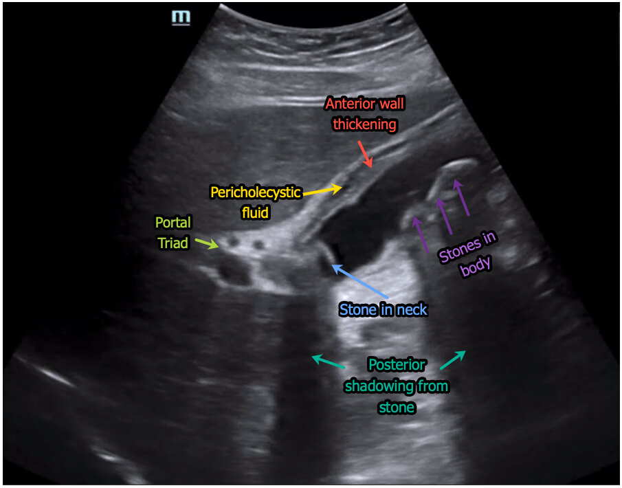 Visualizing Acute Cholecystitis: Ultrasound Images Unveiled